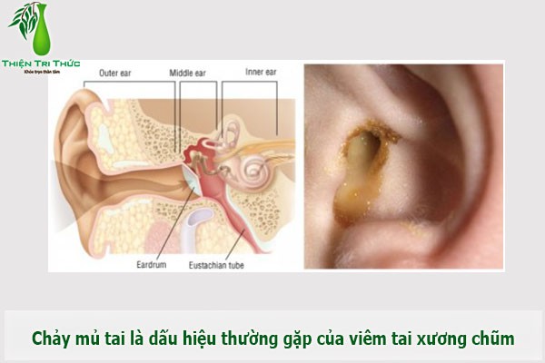 Nam y nghiệm phương Viêm tai xương chũm