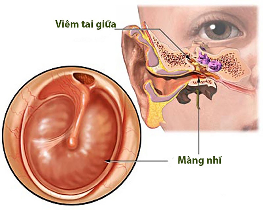 Phẫu thuật Viêm tai giữa